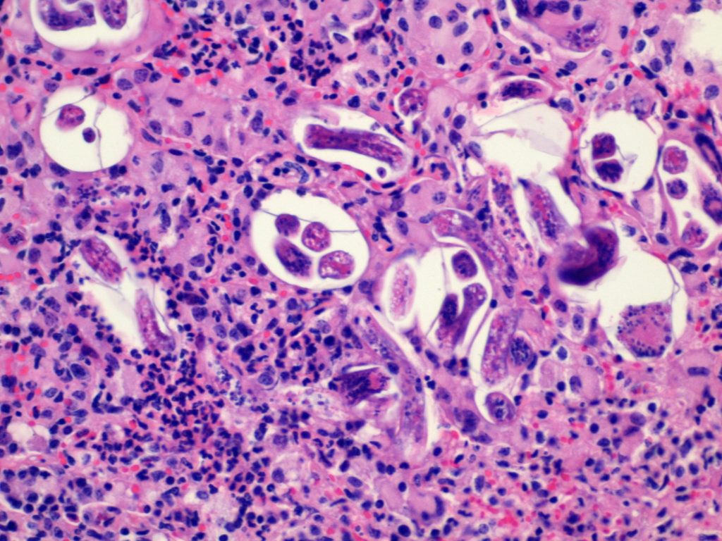 Photograph below: Lungworm larvae in alveoli with associated inflammation. H&E 200x.